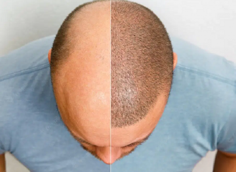 Questions and facts about Hair Transplant surgery